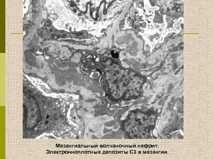 Мезангиальный волчаночный нефрит. Электронноплотные депозиты С 3 в мезангии. 