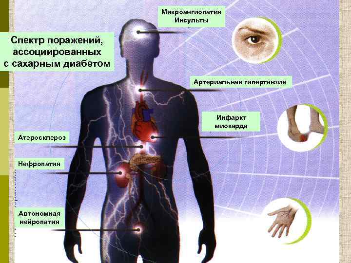 Микроангиопатия Инсульты Спектр поражений, ассоциированных с сахарным диабетом Артериальная гипертензия Инфаркт миокарда Атеросклероз Нефропатия