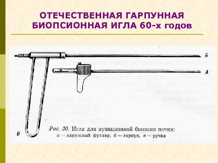 ОТЕЧЕСТВЕННАЯ ГАРПУННАЯ БИОПСИОННАЯ ИГЛА 60 -х годов 