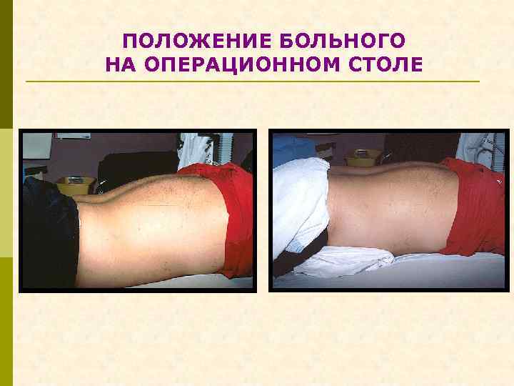 ПОЛОЖЕНИЕ БОЛЬНОГО НА ОПЕРАЦИОННОМ СТОЛЕ 