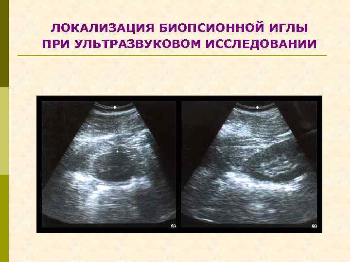 ЛОКАЛИЗАЦИЯ БИОПСИОННОЙ ИГЛЫ ПРИ УЛЬТРАЗВУКОВОМ ИССЛЕДОВАНИИ 