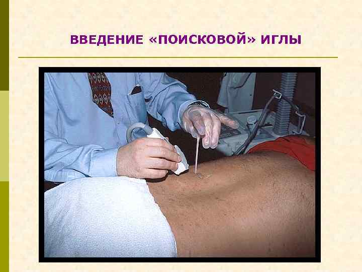 ВВЕДЕНИЕ «ПОИСКОВОЙ» ИГЛЫ 