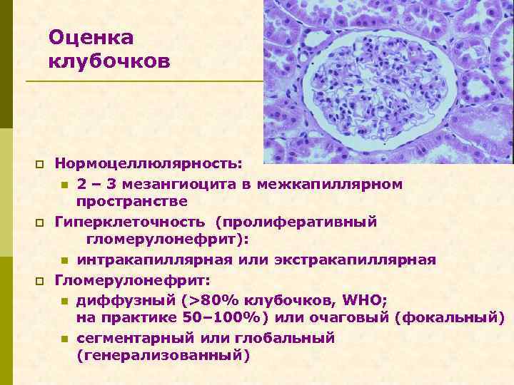 Оценка клубочков p p p Нормоцеллюлярность: n 2 – 3 мезангиоцита в межкапиллярном пространстве