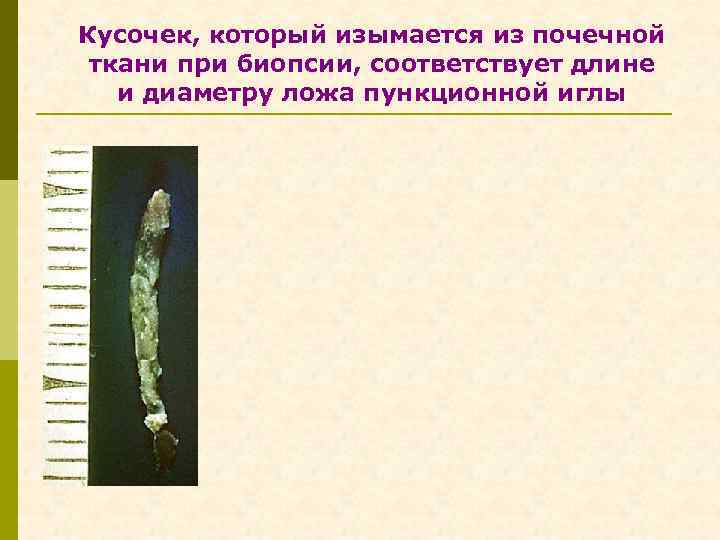 Кусочек, который изымается из почечной ткани при биопсии, соответствует длине и диаметру ложа пункционной