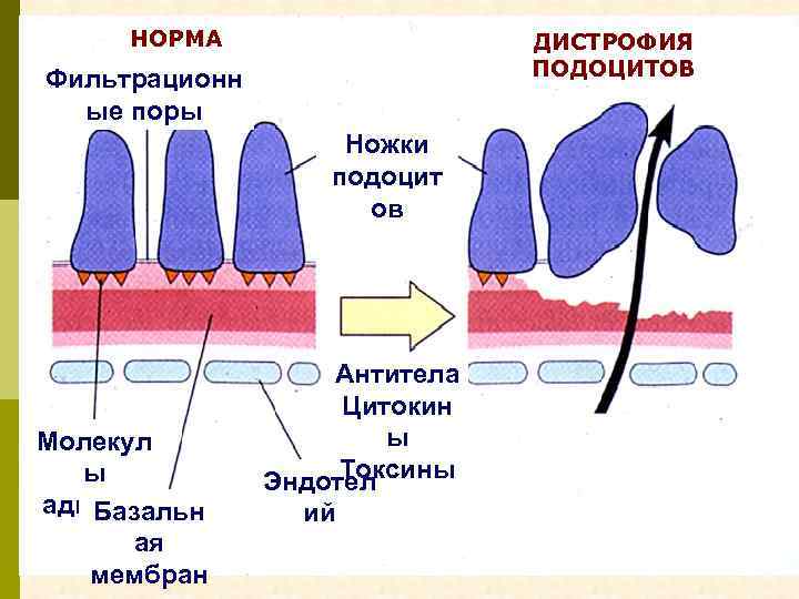 НОРМА ДИСТРОФИЯ ПОДОЦИТОВ Фильтрационн ые поры Ножки подоцит ов Молекул ы адгезии Базальн ая