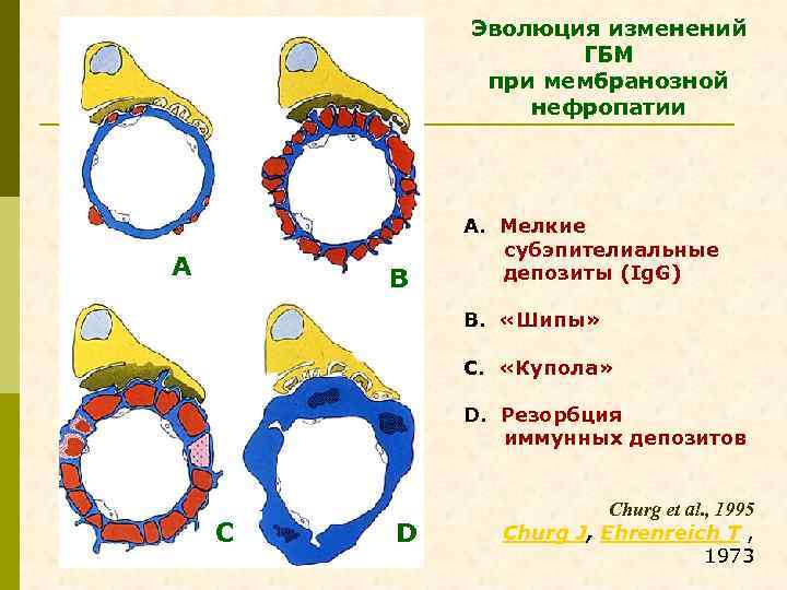 Эволюция изменений ГБМ при мембранозной нефропатии А B А. Мелкие субэпителиальные депозиты (Ig. G)