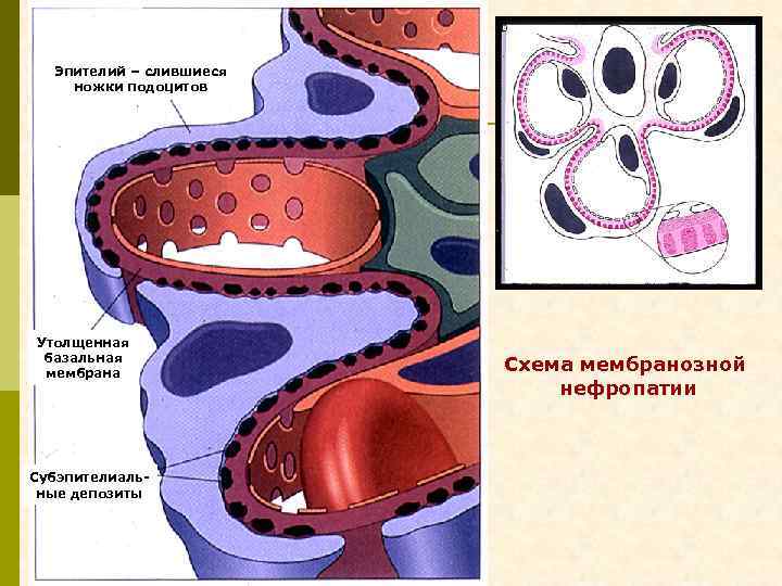 Эпителий – слившиеся ножки подоцитов Утолщенная базальная мембрана Субэпителиальные депозиты Схема мембранозной нефропатии 