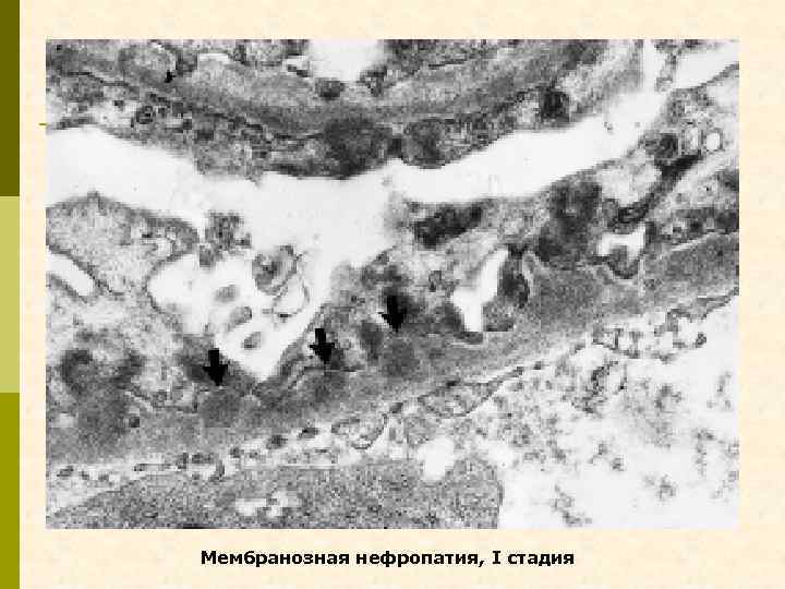 Мембранозная нефропатия, I стадия 