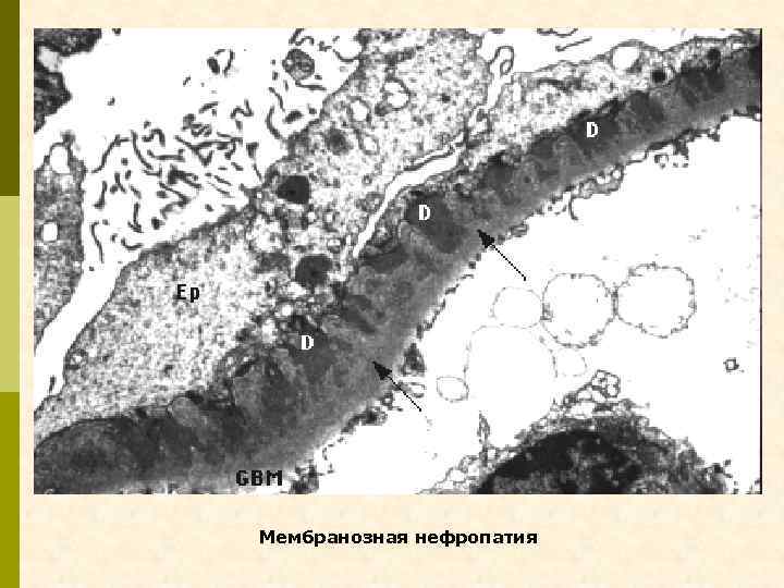 Мембранозная нефропатия 