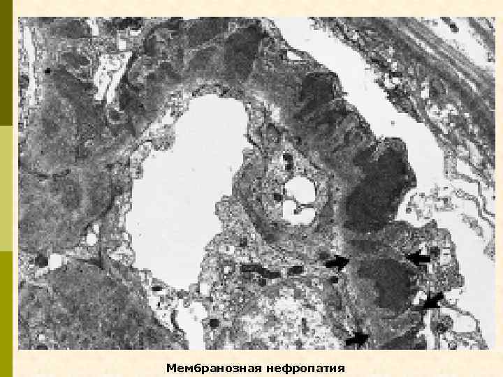 Мембранозная нефропатия 