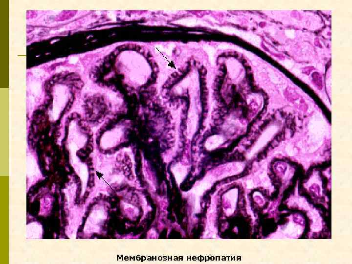 Мембранозная нефропатия 