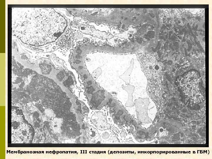 Мембранозная нефропатия, III стадия (депозиты, инкорпорированные в ГБМ) 