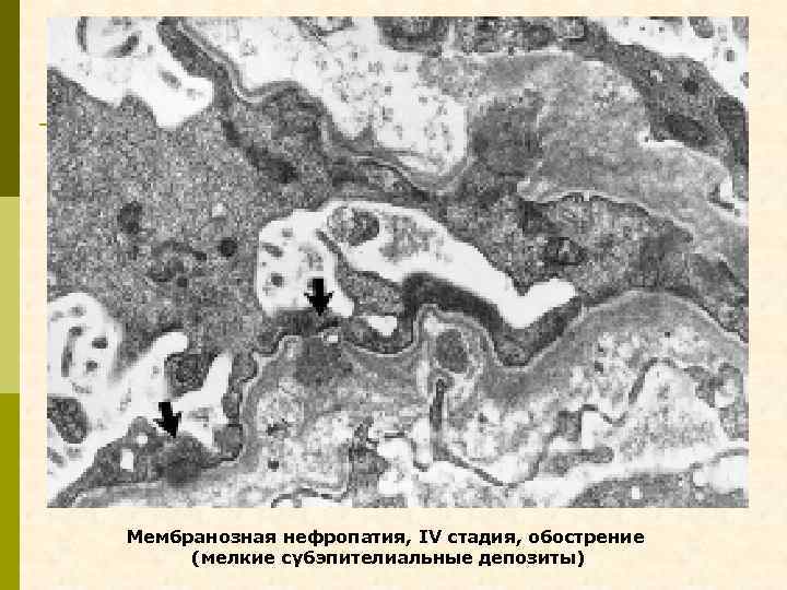Мембранозная нефропатия, IV стадия, обострение (мелкие субэпителиальные депозиты) 