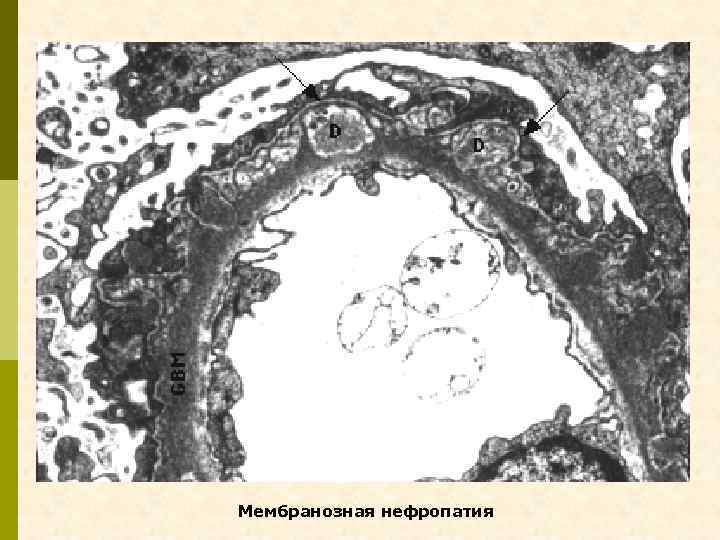 Мембранозная нефропатия 