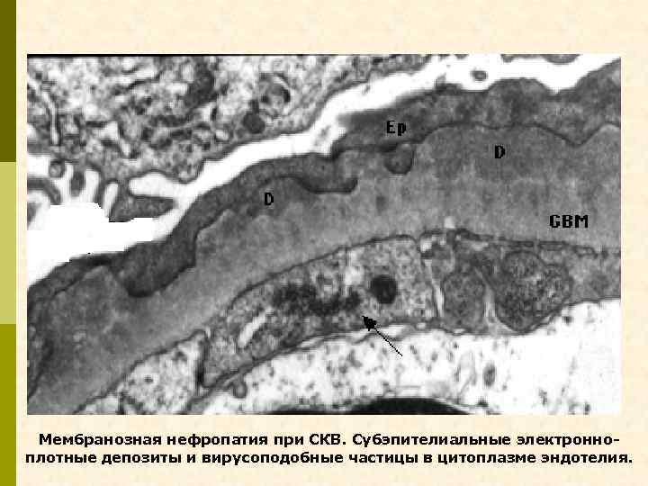 Мембранозная нефропатия при СКВ. Субэпителиальные электронноплотные депозиты и вирусоподобные частицы в цитоплазме эндотелия. 