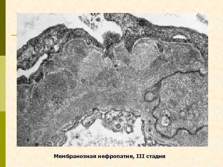 Мембранозная нефропатия, III стадия 
