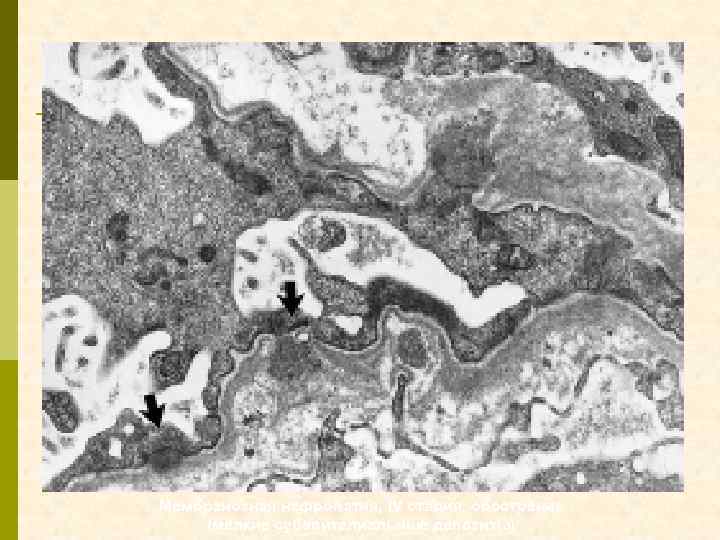 Мембранозная нефропатия, IV стадия, обострение (мелкие субэпителиальные депозиты) 