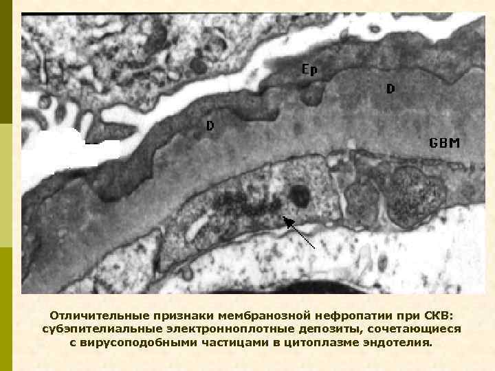 Отличительные признаки мембранозной нефропатии при СКВ: субэпителиальные электронноплотные депозиты, сочетающиеся с вирусоподобными частицами в