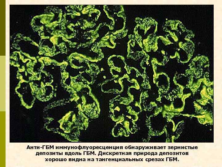 Анти-ГБМ иммунофлуоресценция обнаруживает зернистые депозиты вдоль ГБМ. Дискретная природа депозитов хорошо видна на тангенциальных