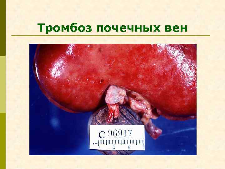 Тромбоз почечных вен 