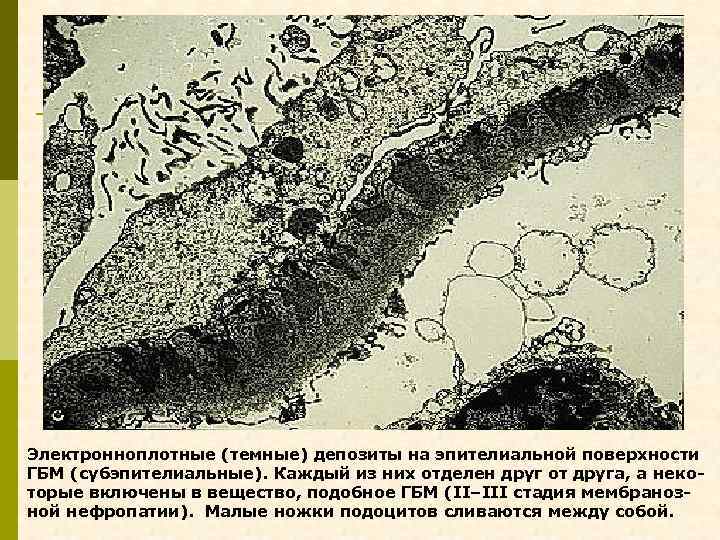Электронноплотные (темные) депозиты на эпителиальной поверхности ГБМ (субэпителиальные). Каждый из них отделен друг от