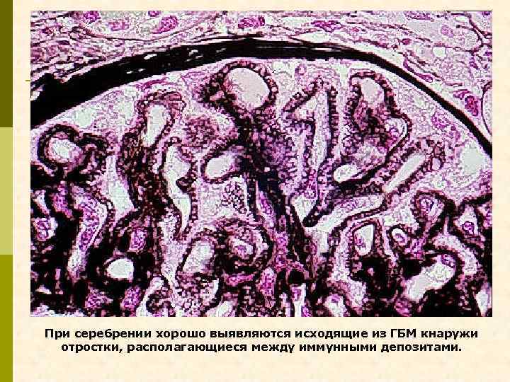 При серебрении хорошо выявляются исходящие из ГБМ кнаружи отростки, располагающиеся между иммунными депозитами. 