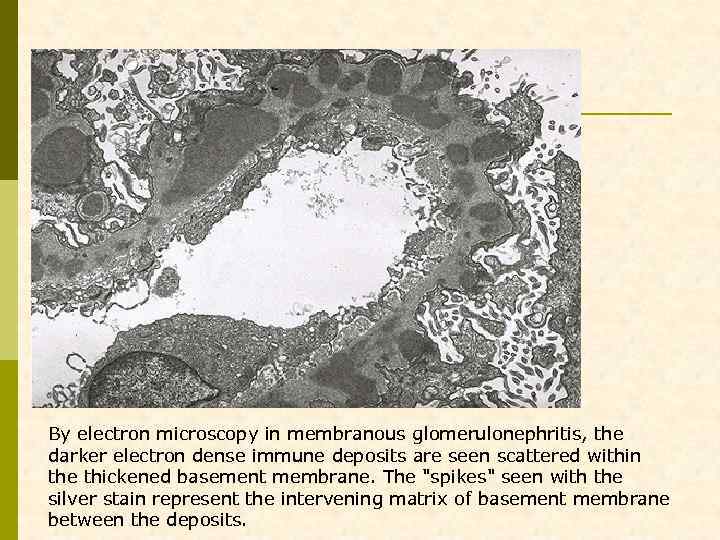 By electron microscopy in membranous glomerulonephritis, the darker electron dense immune deposits are seen