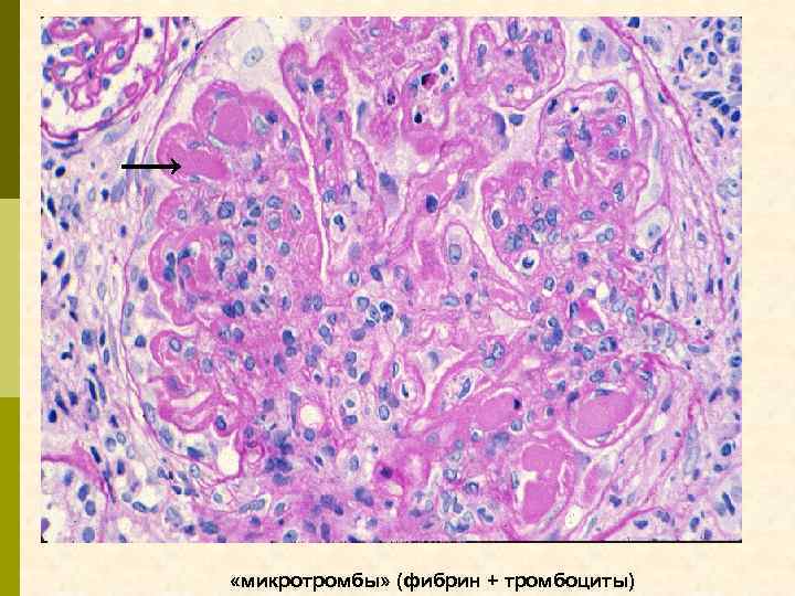  «микротромбы» (фибрин + тромбоциты) 