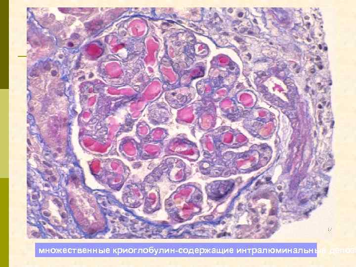 множественные криоглобулин-содержащие интралюминальные депози 