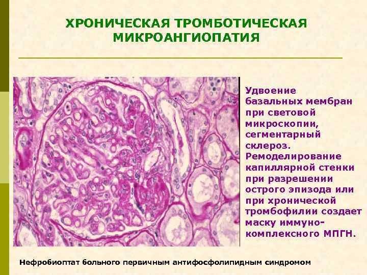 ХРОНИЧЕСКАЯ ТРОМБОТИЧЕСКАЯ МИКРОАНГИОПАТИЯ Удвоение базальных мембран при световой микроскопии, сегментарный склероз. Ремоделирование капиллярной стенки