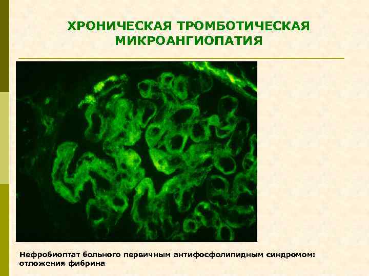 ХРОНИЧЕСКАЯ ТРОМБОТИЧЕСКАЯ МИКРОАНГИОПАТИЯ Нефробиоптат больного первичным антифосфолипидным синдромом: отложения фибрина 
