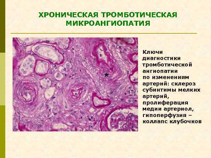 ХРОНИЧЕСКАЯ ТРОМБОТИЧЕСКАЯ МИКРОАНГИОПАТИЯ * Ключи диагностики тромботической ангиопатии по изменениям артерий: склероз субинтимы мелких