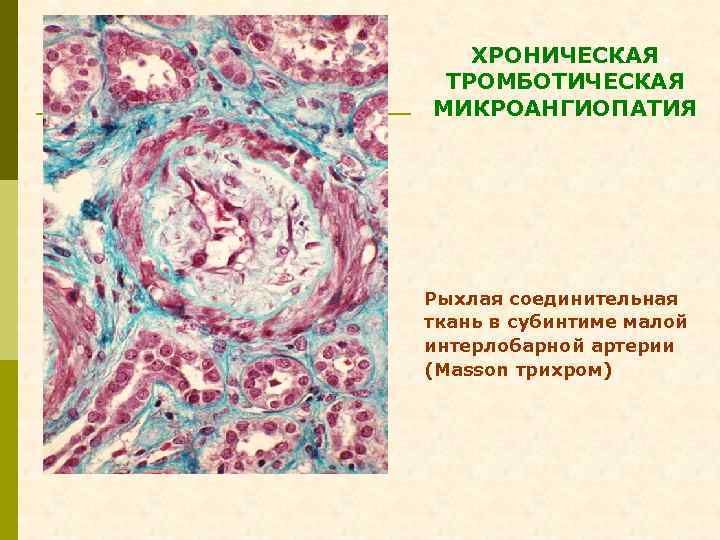 ХРОНИЧЕСКАЯ ТРОМБОТИЧЕСКАЯ МИКРОАНГИОПАТИЯ Рыхлая соединительная ткань в субинтиме малой интерлобарной артерии (Masson трихром) 