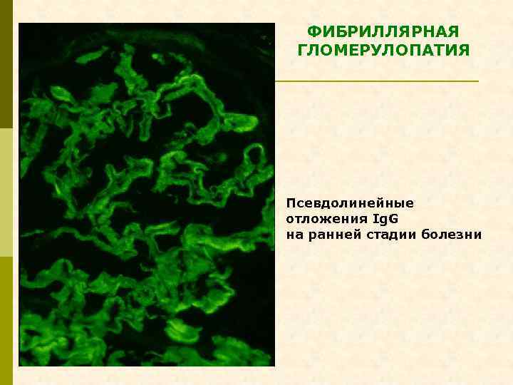 ФИБРИЛЛЯРНАЯ ГЛОМЕРУЛОПАТИЯ Псевдолинейные отложения Ig. G на ранней стадии болезни 