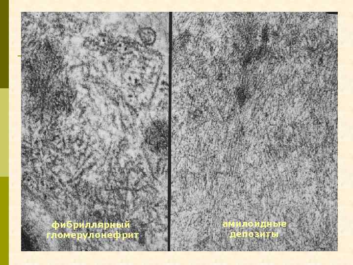 фибриллярный гломерулонефрит амилоидные депозиты 
