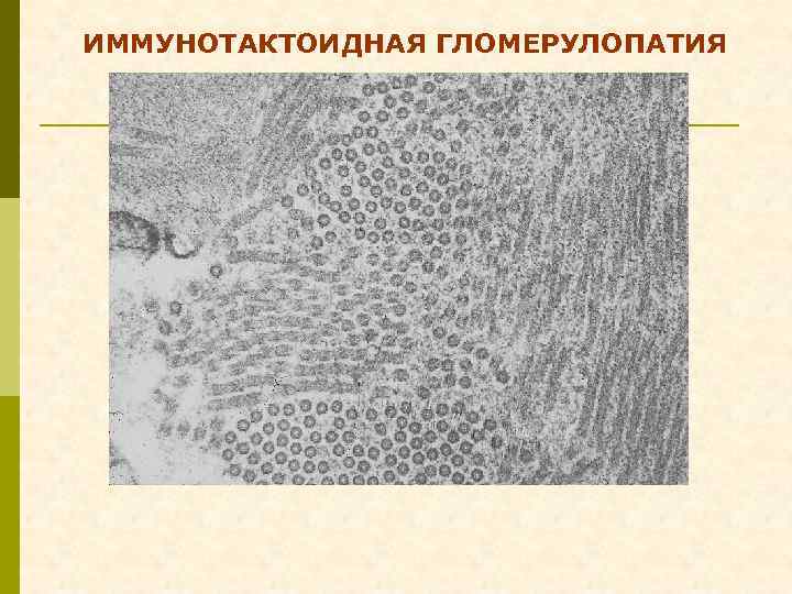 ИММУНОТАКТОИДНАЯ ГЛОМЕРУЛОПАТИЯ 