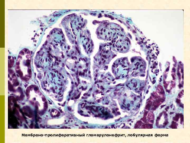 Мембрано-пролиферативный гломерулонефрит, лобулярная форма 