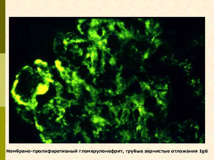 Мембрано-пролиферативный гломерулонефрит, грубые зернистые отложения Ig. G 