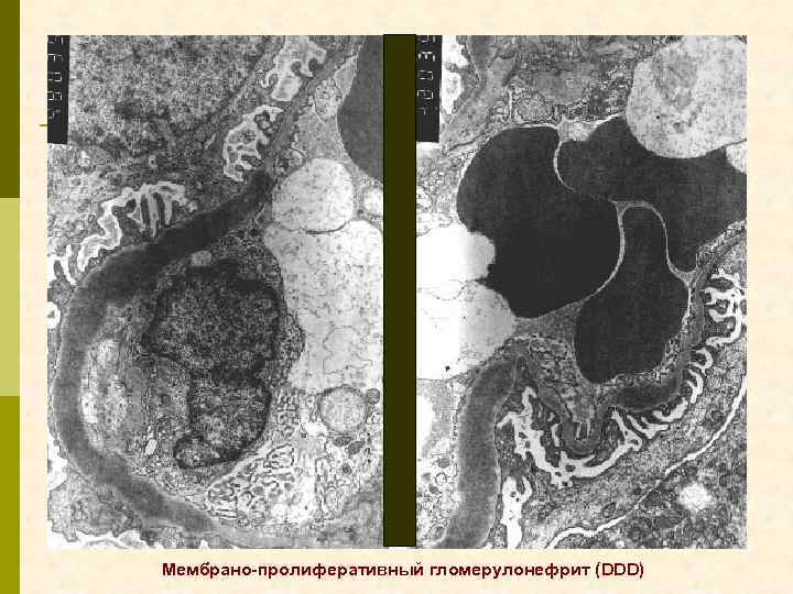 Мембрано-пролиферативный гломерулонефрит (DDD) 