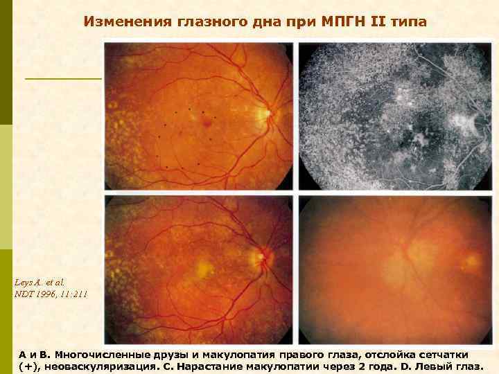 Изменения глазного дна при МПГН II типа Leys A. et al. NDT 1996, 11: