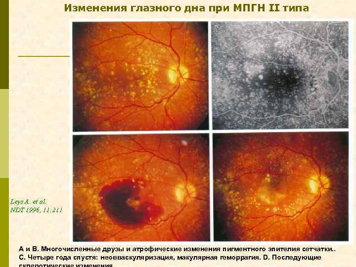 Изменения глазного дна при МПГН II типа Leys A. et al. NDT 1996, 11:
