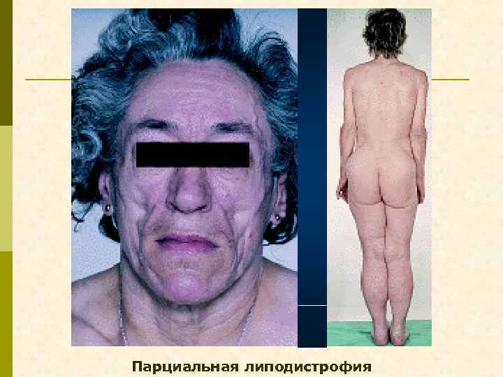 Парциальная липодистрофия 