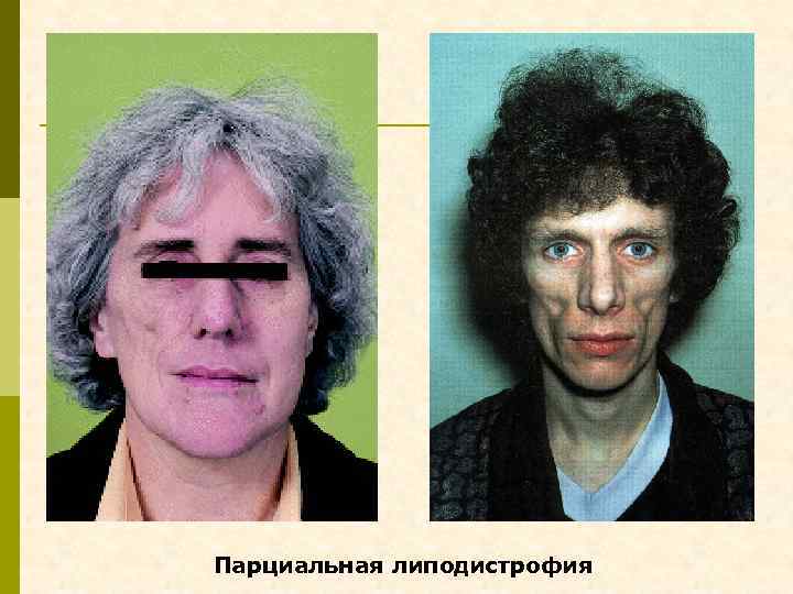 Парциальная липодистрофия 