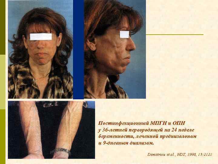 Постинфекционный МПГН и ОПН у 36 -летней первородящей на 24 неделе беременности, леченной преднизолоном