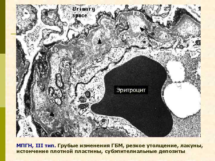 Эритроцит МПГН, III тип. Грубые изменения ГБМ, резкое утолщение, лакуны, истончение плотной пластины, субэпителиальные