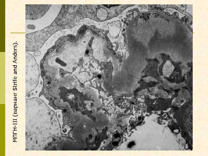 МПГН-III (вариант Strife and Anders). 