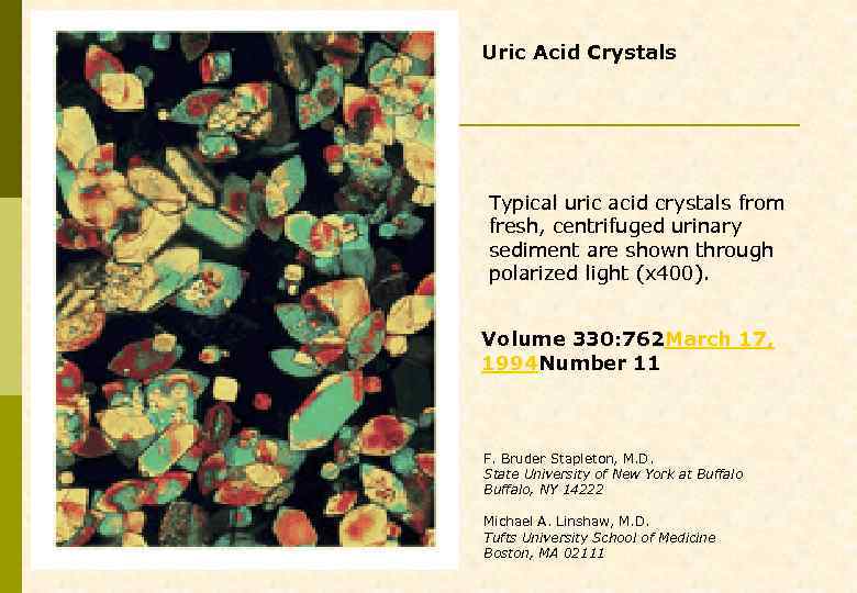 Uric Acid Crystals Typical uric acid crystals from fresh, centrifuged urinary sediment are shown