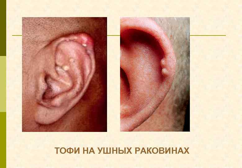 ТОФИ НА УШНЫХ РАКОВИНАХ 