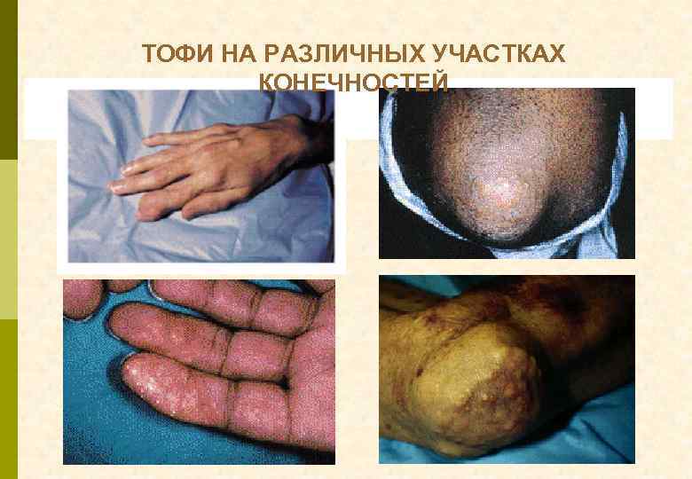 ТОФИ НА РАЗЛИЧНЫХ УЧАСТКАХ КОНЕЧНОСТЕЙ 