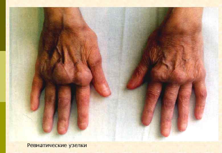 Ревматические узелки 